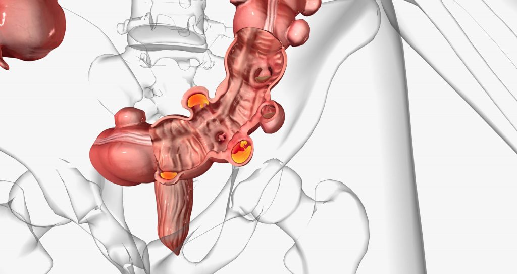 doctores, cirujano, cirujanos, doctoras, cirujano gastrointestinal, cirujano gastrointestinal y laparoscopia, cirujano general, laparoscopía, cirugia, hernias, hernias inguinales, vesícula, vesicula, hemorroides, fisuras anales, apendicectomía, apendicectomia, biopsias, cancer de mama, mastectomia, cáncer de mama, mastectomía, cirugía Conservadora de mama, cirugía Conservadora de mama, ganglio Centinela, seguimiento en cancer de mama, seguimiento en cáncer de mama, check up de la mujer, escleroterapia, úlceras, ulceras, heridas, apendicitis, piedras en vesicula, piedras en riñones, lipomas, proctologos, especialistas en hemorroides, coloproctologo, sindrome intestino irritable, fisuras anales, fistukas anales, abcesos anales, quiste pinolidal, doctores slp, cirujano slp, cirujanos slp, doctoras slp, cirujano gastrointestinal slp, cirujano gastrointestinal y laparoscopia slp, cirujano general slp, laparoscopía slp, cirugia slp, hernias slp, hernias inguinales slp, vesícula slp, vesicula slp, hemorroides slp, fisuras anales slp, apendicectomía slp, apendicectomia slp, biopsias slp, cancer de mama slp, mastectomia slp, cáncer de mama slp, mastectomía slp, cirugía Conservadora de mama slp, cirugía Conservadora de mama slp, ganglio Centinela slp, seguimiento en cancer de mama slp, seguimiento en cáncer de mama slp, check up de la mujer slp, escleroterapia slp, úlceras slp, ulceras slp, heridas slp, apendicitis slp, piedras en vesicula slp, piedras en riñones slp, lipomas slp, proctologos slp, especialistas en hemorroides slp, coloproctologo slp, sindrome intestino irritable slp, fisuras anales slp, fistukas anales slp, abcesos anales, quiste pinolidal slp, doctores san luis potosi, cirujano san luis potosi, cirujanos san luis potosi, doctoras san luis potosi, cirujano gastrointestinal san luis potosi, cirujano gastrointestinal y laparoscopia san luis potosi, cirujano general san luis potosi, laparoscopía san luis potosi, cirugia san luis potosi, hernias san luis potosi, hernias inguinales san luis potosi, vesícula san luis potosi, vesicula san luis potosi, hemorroides san luis potosi, fisuras anales san luis potosi, apendicectomía san luis potosi, apendicectomia san luis potosi, biopsias san luis potosi, cancer de mama san luis potosi, mastectomia san luis potosi, cáncer de mama san luis potosi, mastectomía san luis potosi, cirugía Conservadora de mama san luis potosi, cirugía Conservadora de mama san luis potosi, ganglio Centinela san luis potosi, seguimiento en cancer de mama san luis potosi, seguimiento en cáncer de mama san luis potosi, check up de la mujer san luis potosi, escleroterapia san luis potosi, úlceras san luis potosi, ulceras san luis potosi, heridas san luis potosi, apendicitis san luis potosi, piedras en vesicula san luis potosi, piedras en riñones san luis potosi, lipomas san luis potosi, doctores san luis potosí, cirujano san luis potosí, cirujanos san luis potosí, doctoras san luis potosí, cirujano gastrointestinal san luis potosí, cirujano gastrointestinal y laparoscopia san luis potosí, cirujano general san luis potosí, laparoscopía san luis potosí, cirugia, hernias san luis potosí, hernias inguinales san luis potosí, vesícula san luis potosí, vesicula san luis potosí, hemorroides san luis potosí, fisuras anales san luis potosí, apendicectomía san luis potosí, apendicectomia san luis potosí, biopsias san luis potosí, cancer de mama san luis potosí, mastectomia san luis potosí, cáncer de mama san luis potosí, mastectomía san luis potosí, cirugía Conservadora de mama san luis potosí, cirugía Conservadora de mama san luis potosí, ganglio Centinela san luis potosí, seguimiento en cancer de mama san luis potosí, seguimiento en cáncer de mama san luis potosí, check up de la mujer san luis potosí, escleroterapia san luis potosí, úlceras, ulceras san luis potosí, heridas san luis potosí, apendicitis san luis potosí, piedras en vesicula san luis potosí, piedras en riñones san luis potosí, lipomas san luis potosí, proctologos en san luis potosi, especialistas en hemorroides en san luis potosi, coloproctologo en san luis potosi, sindrome intestino irritable en san luis potosi, fisuras anales en san luis potosi, fistukas anales en san luis potosi, abcesos anales, quiste pinolidal en san luis potosi,