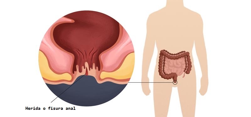 doctores, cirujano, cirujanos, doctoras, cirujano gastrointestinal, cirujano gastrointestinal y laparoscopia, cirujano general, laparoscopía, cirugia, hernias, hernias inguinales, vesícula, vesicula, hemorroides, fisuras anales, apendicectomía, apendicectomia, biopsias, cancer de mama, mastectomia, cáncer de mama, mastectomía, cirugía Conservadora de mama, cirugía Conservadora de mama, ganglio Centinela, seguimiento en cancer de mama, seguimiento en cáncer de mama, check up de la mujer, escleroterapia, úlceras, ulceras, heridas, apendicitis, piedras en vesicula, piedras en riñones, lipomas, proctologos, especialistas en hemorroides, coloproctologo, sindrome intestino irritable, fisuras anales, fistukas anales, abcesos anales, quiste pinolidal, doctores slp, cirujano slp, cirujanos slp, doctoras slp, cirujano gastrointestinal slp, cirujano gastrointestinal y laparoscopia slp, cirujano general slp, laparoscopía slp, cirugia slp, hernias slp, hernias inguinales slp, vesícula slp, vesicula slp, hemorroides slp, fisuras anales slp, apendicectomía slp, apendicectomia slp, biopsias slp, cancer de mama slp, mastectomia slp, cáncer de mama slp, mastectomía slp, cirugía Conservadora de mama slp, cirugía Conservadora de mama slp, ganglio Centinela slp, seguimiento en cancer de mama slp, seguimiento en cáncer de mama slp, check up de la mujer slp, escleroterapia slp, úlceras slp, ulceras slp, heridas slp, apendicitis slp, piedras en vesicula slp, piedras en riñones slp, lipomas slp, proctologos slp, especialistas en hemorroides slp, coloproctologo slp, sindrome intestino irritable slp, fisuras anales slp, fistukas anales slp, abcesos anales, quiste pinolidal slp, doctores san luis potosi, cirujano san luis potosi, cirujanos san luis potosi, doctoras san luis potosi, cirujano gastrointestinal san luis potosi, cirujano gastrointestinal y laparoscopia san luis potosi, cirujano general san luis potosi, laparoscopía san luis potosi, cirugia san luis potosi, hernias san luis potosi, hernias inguinales san luis potosi, vesícula san luis potosi, vesicula san luis potosi, hemorroides san luis potosi, fisuras anales san luis potosi, apendicectomía san luis potosi, apendicectomia san luis potosi, biopsias san luis potosi, cancer de mama san luis potosi, mastectomia san luis potosi, cáncer de mama san luis potosi, mastectomía san luis potosi, cirugía Conservadora de mama san luis potosi, cirugía Conservadora de mama san luis potosi, ganglio Centinela san luis potosi, seguimiento en cancer de mama san luis potosi, seguimiento en cáncer de mama san luis potosi, check up de la mujer san luis potosi, escleroterapia san luis potosi, úlceras san luis potosi, ulceras san luis potosi, heridas san luis potosi, apendicitis san luis potosi, piedras en vesicula san luis potosi, piedras en riñones san luis potosi, lipomas san luis potosi, doctores san luis potosí, cirujano san luis potosí, cirujanos san luis potosí, doctoras san luis potosí, cirujano gastrointestinal san luis potosí, cirujano gastrointestinal y laparoscopia san luis potosí, cirujano general san luis potosí, laparoscopía san luis potosí, cirugia, hernias san luis potosí, hernias inguinales san luis potosí, vesícula san luis potosí, vesicula san luis potosí, hemorroides san luis potosí, fisuras anales san luis potosí, apendicectomía san luis potosí, apendicectomia san luis potosí, biopsias san luis potosí, cancer de mama san luis potosí, mastectomia san luis potosí, cáncer de mama san luis potosí, mastectomía san luis potosí, cirugía Conservadora de mama san luis potosí, cirugía Conservadora de mama san luis potosí, ganglio Centinela san luis potosí, seguimiento en cancer de mama san luis potosí, seguimiento en cáncer de mama san luis potosí, check up de la mujer san luis potosí, escleroterapia san luis potosí, úlceras, ulceras san luis potosí, heridas san luis potosí, apendicitis san luis potosí, piedras en vesicula san luis potosí, piedras en riñones san luis potosí, lipomas san luis potosí, proctologos en san luis potosi, especialistas en hemorroides en san luis potosi, coloproctologo en san luis potosi, sindrome intestino irritable en san luis potosi, fisuras anales en san luis potosi, fistukas anales en san luis potosi, abcesos anales, quiste pinolidal en san luis potosi,