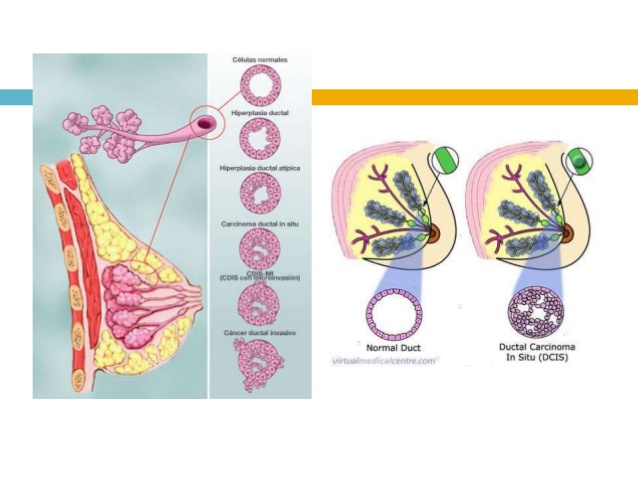 doctores, cirujano, cirujanos, doctoras, cirujano gastrointestinal, cirujano gastrointestinal y laparoscopia, cirujano general, laparoscopía, cirugia, hernias, hernias inguinales, vesícula, vesicula, hemorroides, fisuras anales, apendicectomía, apendicectomia, biopsias, cancer de mama, mastectomia, cáncer de mama, mastectomía, cirugía Conservadora de mama, cirugía Conservadora de mama, ganglio Centinela, seguimiento en cancer de mama, seguimiento en cáncer de mama, check up de la mujer, escleroterapia, úlceras, ulceras, heridas, apendicitis, piedras en vesicula, piedras en riñones, lipomas, doctores slp, cirujano slp, cirujanos slp, doctoras slp, cirujano gastrointestinal slp, cirujano gastrointestinal y laparoscopia slp, cirujano general slp, laparoscopía slp, cirugia slp, hernias slp, hernias inguinales slp, vesícula slp, vesicula slp, hemorroides slp, fisuras anales slp, apendicectomía slp, apendicectomia slp, biopsias slp, cancer de mama slp, mastectomia slp, cáncer de mama slp, mastectomía slp, cirugía Conservadora de mama slp, cirugía Conservadora de mama slp, ganglio Centinela slp, seguimiento en cancer de mama slp, seguimiento en cáncer de mama slp, check up de la mujer slp, escleroterapia slp, úlceras slp, ulceras slp, heridas slp, apendicitis slp, piedras en vesicula slp, piedras en riñones slp, lipomas slp, doctores san luis potosi, cirujano san luis potosi, cirujanos san luis potosi, doctoras san luis potosi, cirujano gastrointestinal san luis potosi, cirujano gastrointestinal y laparoscopia san luis potosi, cirujano general san luis potosi, laparoscopía san luis potosi, cirugia san luis potosi, hernias san luis potosi, hernias inguinales san luis potosi, vesícula san luis potosi, vesicula san luis potosi, hemorroides san luis potosi, fisuras anales san luis potosi, apendicectomía san luis potosi, apendicectomia san luis potosi, biopsias san luis potosi, cancer de mama san luis potosi, mastectomia san luis potosi, cáncer de mama san luis potosi, mastectomía san luis potosi, cirugía Conservadora de mama san luis potosi, cirugía Conservadora de mama san luis potosi, ganglio Centinela san luis potosi, seguimiento en cancer de mama san luis potosi, seguimiento en cáncer de mama san luis potosi, check up de la mujer san luis potosi, escleroterapia san luis potosi, úlceras san luis potosi, ulceras san luis potosi, heridas san luis potosi, apendicitis san luis potosi, piedras en vesicula san luis potosi, piedras en riñones san luis potosi, lipomas san luis potosi, doctores san luis potosí, cirujano san luis potosí, cirujanos san luis potosí, doctoras san luis potosí, cirujano gastrointestinal san luis potosí, cirujano gastrointestinal y laparoscopia san luis potosí, cirujano general san luis potosí, laparoscopía san luis potosí, cirugia, hernias san luis potosí, hernias inguinales san luis potosí, vesícula san luis potosí, vesicula san luis potosí, hemorroides san luis potosí, fisuras anales san luis potosí, apendicectomía san luis potosí, apendicectomia san luis potosí, biopsias san luis potosí, cancer de mama san luis potosí, mastectomia san luis potosí, cáncer de mama san luis potosí, mastectomía san luis potosí, cirugía Conservadora de mama san luis potosí, cirugía Conservadora de mama san luis potosí, ganglio Centinela san luis potosí, seguimiento en cancer de mama san luis potosí, seguimiento en cáncer de mama san luis potosí, check up de la mujer san luis potosí, escleroterapia san luis potosí, úlceras, ulceras san luis potosí, heridas san luis potosí, apendicitis san luis potosí, piedras en vesicula san luis potosí, piedras en riñones san luis potosí, lipomas san luis potosí, Dra. Guadalupe Delgado Cirujano Gastrointestinal en San Luis Potosí, especialista hernias en San Luis Potosi, Especialista piedras en la vesícula en San Luis Potosi, Especialista apendicitis en San Luis Potosi, Especialista hemorroides en San Luis Potosi, Especialista lipomas en San Luis Potosi, Especialista reflujo gastroesofágico en San Luis Potosi, Especialista cáncer de mama en San Luis Potosi, Especialista piedras en la vesicula en San Luis Potosi, Especialista reflujo gastroesofagico en San Luis Potosi, Especialista cancer de mama en San Luis Potosi, especialista hernias en slp, Especialista piedras en la vesícula en slp, Especialista apendicitis en slp, Especialista hemorroides en slp, Especialista lipomas en slp, Especialista reflujo gastroesofágico en slp, Especialista cáncer de mama en slp, Especialista piedras en la vesicula en slp, Especialista reflujo gastroesofagico en slp, Especialista cancer de mama en slp