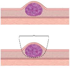 doctores, cirujano, cirujanos, doctoras, cirujano gastrointestinal, cirujano gastrointestinal y laparoscopia, cirujano general, laparoscopía, cirugia, hernias, hernias inguinales, vesícula, vesicula, hemorroides, fisuras anales, apendicectomía, apendicectomia, biopsias, cancer de mama, mastectomia, cáncer de mama, mastectomía, cirugía Conservadora de mama, cirugía Conservadora de mama, ganglio Centinela, seguimiento en cancer de mama, seguimiento en cáncer de mama, check up de la mujer, escleroterapia, úlceras, ulceras, heridas, apendicitis, piedras en vesicula, piedras en riñones, lipomas, doctores slp, cirujano slp, cirujanos slp, doctoras slp, cirujano gastrointestinal slp, cirujano gastrointestinal y laparoscopia slp, cirujano general slp, laparoscopía slp, cirugia slp, hernias slp, hernias inguinales slp, vesícula slp, vesicula slp, hemorroides slp, fisuras anales slp, apendicectomía slp, apendicectomia slp, biopsias slp, cancer de mama slp, mastectomia slp, cáncer de mama slp, mastectomía slp, cirugía Conservadora de mama slp, cirugía Conservadora de mama slp, ganglio Centinela slp, seguimiento en cancer de mama slp, seguimiento en cáncer de mama slp, check up de la mujer slp, escleroterapia slp, úlceras slp, ulceras slp, heridas slp, apendicitis slp, piedras en vesicula slp, piedras en riñones slp, lipomas slp, doctores san luis potosi, cirujano san luis potosi, cirujanos san luis potosi, doctoras san luis potosi, cirujano gastrointestinal san luis potosi, cirujano gastrointestinal y laparoscopia san luis potosi, cirujano general san luis potosi, laparoscopía san luis potosi, cirugia san luis potosi, hernias san luis potosi, hernias inguinales san luis potosi, vesícula san luis potosi, vesicula san luis potosi, hemorroides san luis potosi, fisuras anales san luis potosi, apendicectomía san luis potosi, apendicectomia san luis potosi, biopsias san luis potosi, cancer de mama san luis potosi, mastectomia san luis potosi, cáncer de mama san luis potosi, mastectomía san luis potosi, cirugía Conservadora de mama san luis potosi, cirugía Conservadora de mama san luis potosi, ganglio Centinela san luis potosi, seguimiento en cancer de mama san luis potosi, seguimiento en cáncer de mama san luis potosi, check up de la mujer san luis potosi, escleroterapia san luis potosi, úlceras san luis potosi, ulceras san luis potosi, heridas san luis potosi, apendicitis san luis potosi, piedras en vesicula san luis potosi, piedras en riñones san luis potosi, lipomas san luis potosi, doctores san luis potosí, cirujano san luis potosí, cirujanos san luis potosí, doctoras san luis potosí, cirujano gastrointestinal san luis potosí, cirujano gastrointestinal y laparoscopia san luis potosí, cirujano general san luis potosí, laparoscopía san luis potosí, cirugia, hernias san luis potosí, hernias inguinales san luis potosí, vesícula san luis potosí, vesicula san luis potosí, hemorroides san luis potosí, fisuras anales san luis potosí, apendicectomía san luis potosí, apendicectomia san luis potosí, biopsias san luis potosí, cancer de mama san luis potosí, mastectomia san luis potosí, cáncer de mama san luis potosí, mastectomía san luis potosí, cirugía Conservadora de mama san luis potosí, cirugía Conservadora de mama san luis potosí, ganglio Centinela san luis potosí, seguimiento en cancer de mama san luis potosí, seguimiento en cáncer de mama san luis potosí, check up de la mujer san luis potosí, escleroterapia san luis potosí, úlceras, ulceras san luis potosí, heridas san luis potosí, apendicitis san luis potosí, piedras en vesicula san luis potosí, piedras en riñones san luis potosí, lipomas san luis potosí, Dra. Guadalupe Delgado Cirujano Gastrointestinal en San Luis Potosí, especialista hernias en San Luis Potosi, Especialista piedras en la vesícula en San Luis Potosi, Especialista apendicitis en San Luis Potosi, Especialista hemorroides en San Luis Potosi, Especialista lipomas en San Luis Potosi, Especialista reflujo gastroesofágico en San Luis Potosi, Especialista cáncer de mama en San Luis Potosi, Especialista piedras en la vesicula en San Luis Potosi, Especialista reflujo gastroesofagico en San Luis Potosi, Especialista cancer de mama en San Luis Potosi, especialista hernias en slp, Especialista piedras en la vesícula en slp, Especialista apendicitis en slp, Especialista hemorroides en slp, Especialista lipomas en slp, Especialista reflujo gastroesofágico en slp, Especialista cáncer de mama en slp, Especialista piedras en la vesicula en slp, Especialista reflujo gastroesofagico en slp, Especialista cancer de mama en slp