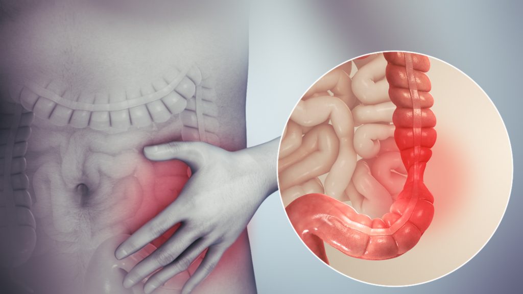 doctores, cirujano, cirujanos, doctoras, cirujano gastrointestinal, cirujano gastrointestinal y laparoscopia, cirujano general, laparoscopía, cirugia, hernias, hernias inguinales, vesícula, vesicula, hemorroides, fisuras anales, apendicectomía, apendicectomia, biopsias, cancer de mama, mastectomia, cáncer de mama, mastectomía, cirugía Conservadora de mama, cirugía Conservadora de mama, ganglio Centinela, seguimiento en cancer de mama, seguimiento en cáncer de mama, check up de la mujer, escleroterapia, úlceras, ulceras, heridas, apendicitis, piedras en vesicula, piedras en riñones, lipomas, proctologos, especialistas en hemorroides, coloproctologo, sindrome intestino irritable, fisuras anales, fistukas anales, abcesos anales, quiste pinolidal, doctores slp, cirujano slp, cirujanos slp, doctoras slp, cirujano gastrointestinal slp, cirujano gastrointestinal y laparoscopia slp, cirujano general slp, laparoscopía slp, cirugia slp, hernias slp, hernias inguinales slp, vesícula slp, vesicula slp, hemorroides slp, fisuras anales slp, apendicectomía slp, apendicectomia slp, biopsias slp, cancer de mama slp, mastectomia slp, cáncer de mama slp, mastectomía slp, cirugía Conservadora de mama slp, cirugía Conservadora de mama slp, ganglio Centinela slp, seguimiento en cancer de mama slp, seguimiento en cáncer de mama slp, check up de la mujer slp, escleroterapia slp, úlceras slp, ulceras slp, heridas slp, apendicitis slp, piedras en vesicula slp, piedras en riñones slp, lipomas slp, proctologos slp, especialistas en hemorroides slp, coloproctologo slp, sindrome intestino irritable slp, fisuras anales slp, fistukas anales slp, abcesos anales, quiste pinolidal slp, doctores san luis potosi, cirujano san luis potosi, cirujanos san luis potosi, doctoras san luis potosi, cirujano gastrointestinal san luis potosi, cirujano gastrointestinal y laparoscopia san luis potosi, cirujano general san luis potosi, laparoscopía san luis potosi, cirugia san luis potosi, hernias san luis potosi, hernias inguinales san luis potosi, vesícula san luis potosi, vesicula san luis potosi, hemorroides san luis potosi, fisuras anales san luis potosi, apendicectomía san luis potosi, apendicectomia san luis potosi, biopsias san luis potosi, cancer de mama san luis potosi, mastectomia san luis potosi, cáncer de mama san luis potosi, mastectomía san luis potosi, cirugía Conservadora de mama san luis potosi, cirugía Conservadora de mama san luis potosi, ganglio Centinela san luis potosi, seguimiento en cancer de mama san luis potosi, seguimiento en cáncer de mama san luis potosi, check up de la mujer san luis potosi, escleroterapia san luis potosi, úlceras san luis potosi, ulceras san luis potosi, heridas san luis potosi, apendicitis san luis potosi, piedras en vesicula san luis potosi, piedras en riñones san luis potosi, lipomas san luis potosi, doctores san luis potosí, cirujano san luis potosí, cirujanos san luis potosí, doctoras san luis potosí, cirujano gastrointestinal san luis potosí, cirujano gastrointestinal y laparoscopia san luis potosí, cirujano general san luis potosí, laparoscopía san luis potosí, cirugia, hernias san luis potosí, hernias inguinales san luis potosí, vesícula san luis potosí, vesicula san luis potosí, hemorroides san luis potosí, fisuras anales san luis potosí, apendicectomía san luis potosí, apendicectomia san luis potosí, biopsias san luis potosí, cancer de mama san luis potosí, mastectomia san luis potosí, cáncer de mama san luis potosí, mastectomía san luis potosí, cirugía Conservadora de mama san luis potosí, cirugía Conservadora de mama san luis potosí, ganglio Centinela san luis potosí, seguimiento en cancer de mama san luis potosí, seguimiento en cáncer de mama san luis potosí, check up de la mujer san luis potosí, escleroterapia san luis potosí, úlceras, ulceras san luis potosí, heridas san luis potosí, apendicitis san luis potosí, piedras en vesicula san luis potosí, piedras en riñones san luis potosí, lipomas san luis potosí, proctologos en san luis potosi, especialistas en hemorroides en san luis potosi, coloproctologo en san luis potosi, sindrome intestino irritable en san luis potosi, fisuras anales en san luis potosi, fistukas anales en san luis potosi, abcesos anales, quiste pinolidal en san luis potosi,