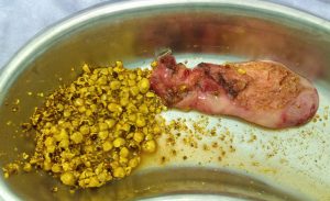 doctores, cirujano, cirujanos, doctoras, cirujano gastrointestinal, cirujano gastrointestinal y laparoscopia, cirujano general, laparoscopía, cirugia, hernias, hernias inguinales, vesícula, vesicula, hemorroides, fisuras anales, apendicectomía, apendicectomia, biopsias, cancer de mama, mastectomia, cáncer de mama, mastectomía, cirugía Conservadora de mama, cirugía Conservadora de mama, ganglio Centinela, seguimiento en cancer de mama, seguimiento en cáncer de mama, check up de la mujer, escleroterapia, úlceras, ulceras, heridas, apendicitis, piedras en vesicula, piedras en riñones, lipomas, doctores slp, cirujano slp, cirujanos slp, doctoras slp, cirujano gastrointestinal slp, cirujano gastrointestinal y laparoscopia slp, cirujano general slp, laparoscopía slp, cirugia slp, hernias slp, hernias inguinales slp, vesícula slp, vesicula slp, hemorroides slp, fisuras anales slp, apendicectomía slp, apendicectomia slp, biopsias slp, cancer de mama slp, mastectomia slp, cáncer de mama slp, mastectomía slp, cirugía Conservadora de mama slp, cirugía Conservadora de mama slp, ganglio Centinela slp, seguimiento en cancer de mama slp, seguimiento en cáncer de mama slp, check up de la mujer slp, escleroterapia slp, úlceras slp, ulceras slp, heridas slp, apendicitis slp, piedras en vesicula slp, piedras en riñones slp, lipomas slp, doctores san luis potosi, cirujano san luis potosi, cirujanos san luis potosi, doctoras san luis potosi, cirujano gastrointestinal san luis potosi, cirujano gastrointestinal y laparoscopia san luis potosi, cirujano general san luis potosi, laparoscopía san luis potosi, cirugia san luis potosi, hernias san luis potosi, hernias inguinales san luis potosi, vesícula san luis potosi, vesicula san luis potosi, hemorroides san luis potosi, fisuras anales san luis potosi, apendicectomía san luis potosi, apendicectomia san luis potosi, biopsias san luis potosi, cancer de mama san luis potosi, mastectomia san luis potosi, cáncer de mama san luis potosi, mastectomía san luis potosi, cirugía Conservadora de mama san luis potosi, cirugía Conservadora de mama san luis potosi, ganglio Centinela san luis potosi, seguimiento en cancer de mama san luis potosi, seguimiento en cáncer de mama san luis potosi, check up de la mujer san luis potosi, escleroterapia san luis potosi, úlceras san luis potosi, ulceras san luis potosi, heridas san luis potosi, apendicitis san luis potosi, piedras en vesicula san luis potosi, piedras en riñones san luis potosi, lipomas san luis potosi, doctores san luis potosí, cirujano san luis potosí, cirujanos san luis potosí, doctoras san luis potosí, cirujano gastrointestinal san luis potosí, cirujano gastrointestinal y laparoscopia san luis potosí, cirujano general san luis potosí, laparoscopía san luis potosí, cirugia, hernias san luis potosí, hernias inguinales san luis potosí, vesícula san luis potosí, vesicula san luis potosí, hemorroides san luis potosí, fisuras anales san luis potosí, apendicectomía san luis potosí, apendicectomia san luis potosí, biopsias san luis potosí, cancer de mama san luis potosí, mastectomia san luis potosí, cáncer de mama san luis potosí, mastectomía san luis potosí, cirugía Conservadora de mama san luis potosí, cirugía Conservadora de mama san luis potosí, ganglio Centinela san luis potosí, seguimiento en cancer de mama san luis potosí, seguimiento en cáncer de mama san luis potosí, check up de la mujer san luis potosí, escleroterapia san luis potosí, úlceras, ulceras san luis potosí, heridas san luis potosí, apendicitis san luis potosí, piedras en vesicula san luis potosí, piedras en riñones san luis potosí, lipomas san luis potosí, Dra. Guadalupe Delgado Cirujano Gastrointestinal en San Luis Potosí, especialista hernias en San Luis Potosi, Especialista piedras en la vesícula en San Luis Potosi, Especialista apendicitis en San Luis Potosi, Especialista hemorroides en San Luis Potosi, Especialista lipomas en San Luis Potosi, Especialista reflujo gastroesofágico en San Luis Potosi, Especialista cáncer de mama en San Luis Potosi, Especialista piedras en la vesicula en San Luis Potosi, Especialista reflujo gastroesofagico en San Luis Potosi, Especialista cancer de mama en San Luis Potosi, especialista hernias en slp, Especialista piedras en la vesícula en slp, Especialista apendicitis en slp, Especialista hemorroides en slp, Especialista lipomas en slp, Especialista reflujo gastroesofágico en slp, Especialista cáncer de mama en slp, Especialista piedras en la vesicula en slp, Especialista reflujo gastroesofagico en slp, Especialista cancer de mama en slp