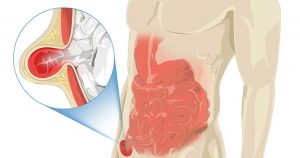 doctores, cirujano, cirujanos, doctoras, cirujano gastrointestinal, cirujano gastrointestinal y laparoscopia, cirujano general, laparoscopía, cirugia, hernias, hernias inguinales, vesícula, vesicula, hemorroides, fisuras anales, apendicectomía, apendicectomia, biopsias, cancer de mama, mastectomia, cáncer de mama, mastectomía, cirugía Conservadora de mama, cirugía Conservadora de mama, ganglio Centinela, seguimiento en cancer de mama, seguimiento en cáncer de mama, check up de la mujer, escleroterapia, úlceras, ulceras, heridas, apendicitis, piedras en vesicula, piedras en riñones, lipomas, doctores slp, cirujano slp, cirujanos slp, doctoras slp, cirujano gastrointestinal slp, cirujano gastrointestinal y laparoscopia slp, cirujano general slp, laparoscopía slp, cirugia slp, hernias slp, hernias inguinales slp, vesícula slp, vesicula slp, hemorroides slp, fisuras anales slp, apendicectomía slp, apendicectomia slp, biopsias slp, cancer de mama slp, mastectomia slp, cáncer de mama slp, mastectomía slp, cirugía Conservadora de mama slp, cirugía Conservadora de mama slp, ganglio Centinela slp, seguimiento en cancer de mama slp, seguimiento en cáncer de mama slp, check up de la mujer slp, escleroterapia slp, úlceras slp, ulceras slp, heridas slp, apendicitis slp, piedras en vesicula slp, piedras en riñones slp, lipomas slp, doctores san luis potosi, cirujano san luis potosi, cirujanos san luis potosi, doctoras san luis potosi, cirujano gastrointestinal san luis potosi, cirujano gastrointestinal y laparoscopia san luis potosi, cirujano general san luis potosi, laparoscopía san luis potosi, cirugia san luis potosi, hernias san luis potosi, hernias inguinales san luis potosi, vesícula san luis potosi, vesicula san luis potosi, hemorroides san luis potosi, fisuras anales san luis potosi, apendicectomía san luis potosi, apendicectomia san luis potosi, biopsias san luis potosi, cancer de mama san luis potosi, mastectomia san luis potosi, cáncer de mama san luis potosi, mastectomía san luis potosi, cirugía Conservadora de mama san luis potosi, cirugía Conservadora de mama san luis potosi, ganglio Centinela san luis potosi, seguimiento en cancer de mama san luis potosi, seguimiento en cáncer de mama san luis potosi, check up de la mujer san luis potosi, escleroterapia san luis potosi, úlceras san luis potosi, ulceras san luis potosi, heridas san luis potosi, apendicitis san luis potosi, piedras en vesicula san luis potosi, piedras en riñones san luis potosi, lipomas san luis potosi, doctores san luis potosí, cirujano san luis potosí, cirujanos san luis potosí, doctoras san luis potosí, cirujano gastrointestinal san luis potosí, cirujano gastrointestinal y laparoscopia san luis potosí, cirujano general san luis potosí, laparoscopía san luis potosí, cirugia, hernias san luis potosí, hernias inguinales san luis potosí, vesícula san luis potosí, vesicula san luis potosí, hemorroides san luis potosí, fisuras anales san luis potosí, apendicectomía san luis potosí, apendicectomia san luis potosí, biopsias san luis potosí, cancer de mama san luis potosí, mastectomia san luis potosí, cáncer de mama san luis potosí, mastectomía san luis potosí, cirugía Conservadora de mama san luis potosí, cirugía Conservadora de mama san luis potosí, ganglio Centinela san luis potosí, seguimiento en cancer de mama san luis potosí, seguimiento en cáncer de mama san luis potosí, check up de la mujer san luis potosí, escleroterapia san luis potosí, úlceras, ulceras san luis potosí, heridas san luis potosí, apendicitis san luis potosí, piedras en vesicula san luis potosí, piedras en riñones san luis potosí, lipomas san luis potosí, Dra. Guadalupe Delgado Cirujano Gastrointestinal en San Luis Potosí, especialista hernias en San Luis Potosi, Especialista piedras en la vesícula en San Luis Potosi, Especialista apendicitis en San Luis Potosi, Especialista hemorroides en San Luis Potosi, Especialista lipomas en San Luis Potosi, Especialista reflujo gastroesofágico en San Luis Potosi, Especialista cáncer de mama en San Luis Potosi, Especialista piedras en la vesicula en San Luis Potosi, Especialista reflujo gastroesofagico en San Luis Potosi, Especialista cancer de mama en San Luis Potosi, especialista hernias en slp, Especialista piedras en la vesícula en slp, Especialista apendicitis en slp, Especialista hemorroides en slp, Especialista lipomas en slp, Especialista reflujo gastroesofágico en slp, Especialista cáncer de mama en slp, Especialista piedras en la vesicula en slp, Especialista reflujo gastroesofagico en slp, Especialista cancer de mama en slp