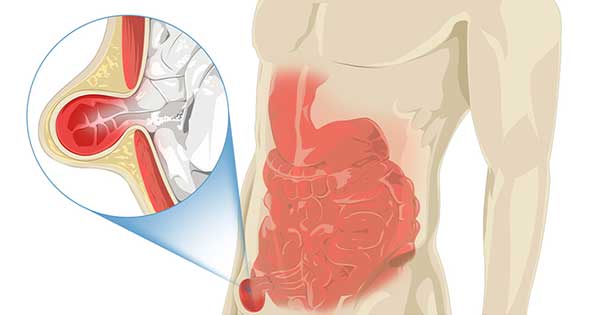 doctores, cirujano, cirujanos, doctoras, cirujano gastrointestinal, cirujano gastrointestinal y laparoscopia, cirujano general, laparoscopía, cirugia, hernias, hernias inguinales, vesícula, vesicula, hemorroides, fisuras anales, apendicectomía, apendicectomia, biopsias, cancer de mama, mastectomia, cáncer de mama, mastectomía, cirugía Conservadora de mama, cirugía Conservadora de mama, ganglio Centinela, seguimiento en cancer de mama, seguimiento en cáncer de mama, check up de la mujer, escleroterapia, úlceras, ulceras, heridas, apendicitis, piedras en vesicula, piedras en riñones, lipomas, doctores slp, cirujano slp, cirujanos slp, doctoras slp, cirujano gastrointestinal slp, cirujano gastrointestinal y laparoscopia slp, cirujano general slp, laparoscopía slp, cirugia slp, hernias slp, hernias inguinales slp, vesícula slp, vesicula slp, hemorroides slp, fisuras anales slp, apendicectomía slp, apendicectomia slp, biopsias slp, cancer de mama slp, mastectomia slp, cáncer de mama slp, mastectomía slp, cirugía Conservadora de mama slp, cirugía Conservadora de mama slp, ganglio Centinela slp, seguimiento en cancer de mama slp, seguimiento en cáncer de mama slp, check up de la mujer slp, escleroterapia slp, úlceras slp, ulceras slp, heridas slp, apendicitis slp, piedras en vesicula slp, piedras en riñones slp, lipomas slp, doctores san luis potosi, cirujano san luis potosi, cirujanos san luis potosi, doctoras san luis potosi, cirujano gastrointestinal san luis potosi, cirujano gastrointestinal y laparoscopia san luis potosi, cirujano general san luis potosi, laparoscopía san luis potosi, cirugia san luis potosi, hernias san luis potosi, hernias inguinales san luis potosi, vesícula san luis potosi, vesicula san luis potosi, hemorroides san luis potosi, fisuras anales san luis potosi, apendicectomía san luis potosi, apendicectomia san luis potosi, biopsias san luis potosi, cancer de mama san luis potosi, mastectomia san luis potosi, cáncer de mama san luis potosi, mastectomía san luis potosi, cirugía Conservadora de mama san luis potosi, cirugía Conservadora de mama san luis potosi, ganglio Centinela san luis potosi, seguimiento en cancer de mama san luis potosi, seguimiento en cáncer de mama san luis potosi, check up de la mujer san luis potosi, escleroterapia san luis potosi, úlceras san luis potosi, ulceras san luis potosi, heridas san luis potosi, apendicitis san luis potosi, piedras en vesicula san luis potosi, piedras en riñones san luis potosi, lipomas san luis potosi, doctores san luis potosí, cirujano san luis potosí, cirujanos san luis potosí, doctoras san luis potosí, cirujano gastrointestinal san luis potosí, cirujano gastrointestinal y laparoscopia san luis potosí, cirujano general san luis potosí, laparoscopía san luis potosí, cirugia, hernias san luis potosí, hernias inguinales san luis potosí, vesícula san luis potosí, vesicula san luis potosí, hemorroides san luis potosí, fisuras anales san luis potosí, apendicectomía san luis potosí, apendicectomia san luis potosí, biopsias san luis potosí, cancer de mama san luis potosí, mastectomia san luis potosí, cáncer de mama san luis potosí, mastectomía san luis potosí, cirugía Conservadora de mama san luis potosí, cirugía Conservadora de mama san luis potosí, ganglio Centinela san luis potosí, seguimiento en cancer de mama san luis potosí, seguimiento en cáncer de mama san luis potosí, check up de la mujer san luis potosí, escleroterapia san luis potosí, úlceras, ulceras san luis potosí, heridas san luis potosí, apendicitis san luis potosí, piedras en vesicula san luis potosí, piedras en riñones san luis potosí, lipomas san luis potosí, Dra. Guadalupe Delgado Cirujano Gastrointestinal en San Luis Potosí, especialista hernias en San Luis Potosi, Especialista piedras en la vesícula en San Luis Potosi, Especialista apendicitis en San Luis Potosi, Especialista hemorroides en San Luis Potosi, Especialista lipomas en San Luis Potosi, Especialista reflujo gastroesofágico en San Luis Potosi, Especialista cáncer de mama en San Luis Potosi, Especialista piedras en la vesicula en San Luis Potosi, Especialista reflujo gastroesofagico en San Luis Potosi, Especialista cancer de mama en San Luis Potosi, especialista hernias en slp, Especialista piedras en la vesícula en slp, Especialista apendicitis en slp, Especialista hemorroides en slp, Especialista lipomas en slp, Especialista reflujo gastroesofágico en slp, Especialista cáncer de mama en slp, Especialista piedras en la vesicula en slp, Especialista reflujo gastroesofagico en slp, Especialista cancer de mama en slp