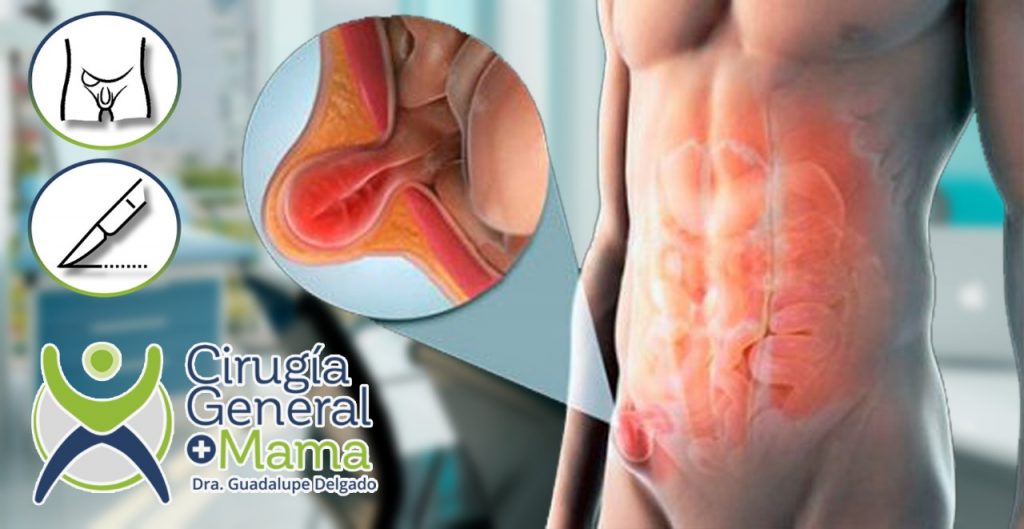 doctores, cirujano, cirujanos, doctoras, cirujano gastrointestinal, cirujano gastrointestinal y laparoscopia, cirujano general, laparoscopía, cirugia, hernias, hernias inguinales, vesícula, vesicula, hemorroides, fisuras anales, apendicectomía, apendicectomia, biopsias, cancer de mama, mastectomia, cáncer de mama, mastectomía, cirugía Conservadora de mama, cirugía Conservadora de mama, ganglio Centinela, seguimiento en cancer de mama, seguimiento en cáncer de mama, check up de la mujer, escleroterapia, úlceras, ulceras, heridas, apendicitis, piedras en vesicula, piedras en riñones, lipomas, doctores slp, cirujano slp, cirujanos slp, doctoras slp, cirujano gastrointestinal slp, cirujano gastrointestinal y laparoscopia slp, cirujano general slp, laparoscopía slp, cirugia slp, hernias slp, hernias inguinales slp, vesícula slp, vesicula slp, hemorroides slp, fisuras anales slp, apendicectomía slp, apendicectomia slp, biopsias slp, cancer de mama slp, mastectomia slp, cáncer de mama slp, mastectomía slp, cirugía Conservadora de mama slp, cirugía Conservadora de mama slp, ganglio Centinela slp, seguimiento en cancer de mama slp, seguimiento en cáncer de mama slp, check up de la mujer slp, escleroterapia slp, úlceras slp, ulceras slp, heridas slp, apendicitis slp, piedras en vesicula slp, piedras en riñones slp, lipomas slp, doctores san luis potosi, cirujano san luis potosi, cirujanos san luis potosi, doctoras san luis potosi, cirujano gastrointestinal san luis potosi, cirujano gastrointestinal y laparoscopia san luis potosi, cirujano general san luis potosi, laparoscopía san luis potosi, cirugia san luis potosi, hernias san luis potosi, hernias inguinales san luis potosi, vesícula san luis potosi, vesicula san luis potosi, hemorroides san luis potosi, fisuras anales san luis potosi, apendicectomía san luis potosi, apendicectomia san luis potosi, biopsias san luis potosi, cancer de mama san luis potosi, mastectomia san luis potosi, cáncer de mama san luis potosi, mastectomía san luis potosi, cirugía Conservadora de mama san luis potosi, cirugía Conservadora de mama san luis potosi, ganglio Centinela san luis potosi, seguimiento en cancer de mama san luis potosi, seguimiento en cáncer de mama san luis potosi, check up de la mujer san luis potosi, escleroterapia san luis potosi, úlceras san luis potosi, ulceras san luis potosi, heridas san luis potosi, apendicitis san luis potosi, piedras en vesicula san luis potosi, piedras en riñones san luis potosi, lipomas san luis potosi, doctores san luis potosí, cirujano san luis potosí, cirujanos san luis potosí, doctoras san luis potosí, cirujano gastrointestinal san luis potosí, cirujano gastrointestinal y laparoscopia san luis potosí, cirujano general san luis potosí, laparoscopía san luis potosí, cirugia, hernias san luis potosí, hernias inguinales san luis potosí, vesícula san luis potosí, vesicula san luis potosí, hemorroides san luis potosí, fisuras anales san luis potosí, apendicectomía san luis potosí, apendicectomia san luis potosí, biopsias san luis potosí, cancer de mama san luis potosí, mastectomia san luis potosí, cáncer de mama san luis potosí, mastectomía san luis potosí, cirugía Conservadora de mama san luis potosí, cirugía Conservadora de mama san luis potosí, ganglio Centinela san luis potosí, seguimiento en cancer de mama san luis potosí, seguimiento en cáncer de mama san luis potosí, check up de la mujer san luis potosí, escleroterapia san luis potosí, úlceras, ulceras san luis potosí, heridas san luis potosí, apendicitis san luis potosí, piedras en vesicula san luis potosí, piedras en riñones san luis potosí, lipomas san luis potosí, Dra. Guadalupe Delgado Cirujano Gastrointestinal en San Luis Potosí, especialista hernias en San Luis Potosi, Especialista piedras en la vesícula en San Luis Potosi, Especialista apendicitis en San Luis Potosi, Especialista hemorroides en San Luis Potosi, Especialista lipomas en San Luis Potosi, Especialista reflujo gastroesofágico en San Luis Potosi, Especialista cáncer de mama en San Luis Potosi, Especialista piedras en la vesicula en San Luis Potosi, Especialista reflujo gastroesofagico en San Luis Potosi, Especialista cancer de mama en San Luis Potosi, especialista hernias en slp, Especialista piedras en la vesícula en slp, Especialista apendicitis en slp, Especialista hemorroides en slp, Especialista lipomas en slp, Especialista reflujo gastroesofágico en slp, Especialista cáncer de mama en slp, Especialista piedras en la vesicula en slp, Especialista reflujo gastroesofagico en slp, Especialista cancer de mama en slp